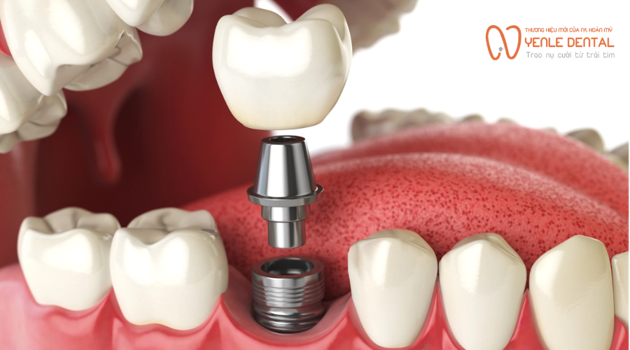 trồng implant là gì
